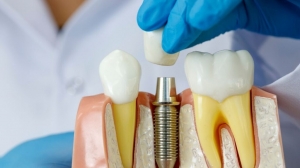 Debunking the Five Most Common Myths About Dental Implants Debunking the Five Most Common Myths About Dental Implants